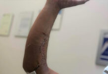 Πρωτοποριακή μικροχειρουργική επέμβαση απέτρεψε ακρωτηριασμό εργάτη